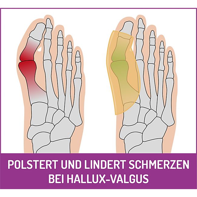 babybutt FußGut Hallux Überbeinschutz 1 Paar Verkauf